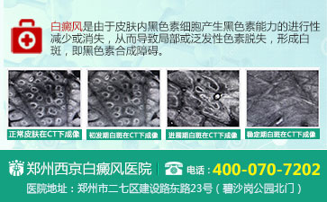白癜风的原因是什么